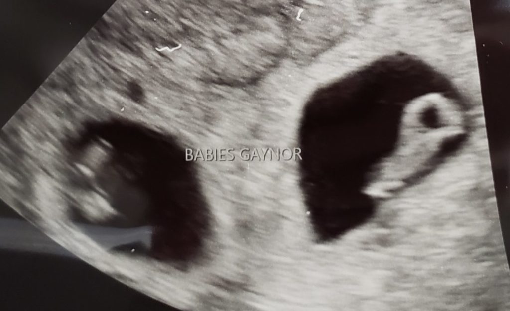 Weeks ultrasound 8 pregnant 8 Weeks