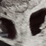 6w4d ultrasound, twins #4