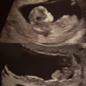 Miscarriage of one twin. Baby A measured on par with gestational age of 12w2d, had a healthy heart rate, and wiggled a bunch. Baby B measured 8w5d and had no heartbeat.